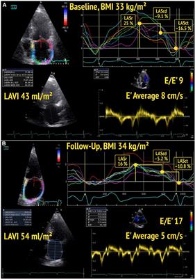 Impact of body mass index on worsening of diastolic function and impairment of left atrial strain in the general female urban population: a subanalysis of the Berlin female risk evaluation echocardiography follow-up study